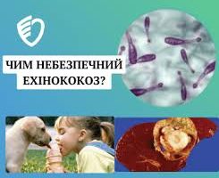 Ехінококоз: порали лікаря